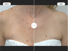 Load image into Gallery viewer, BBL HEROic Face; 1 Treatment - Back to School 2025 Promo
