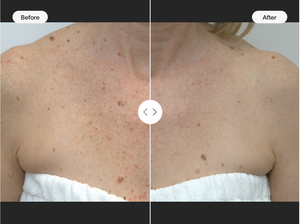 BBL HEROic Face; 1 Treatment - Back to School 2025 Promo