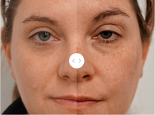 Load image into Gallery viewer, BBL HEROic Face; 1 Treatment - Back to School 2025 Promo
