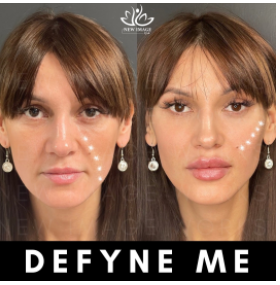 Defyne Me + 1 Syringe FREE - August 2025 Special