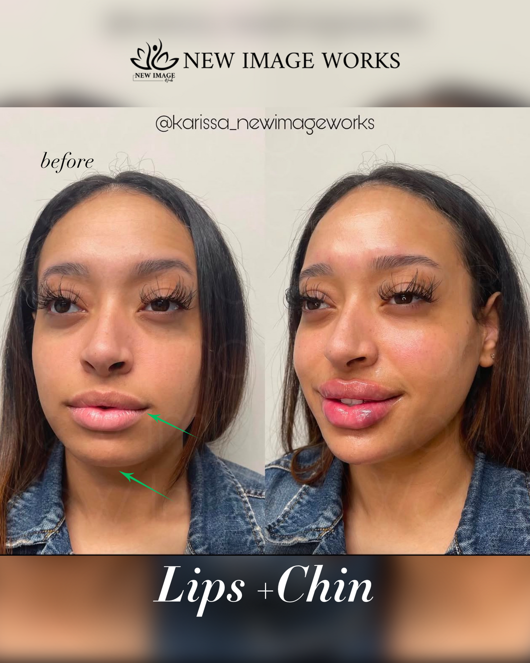 Lips & Chin: 2 Juvederm Syringes February 2025 Special