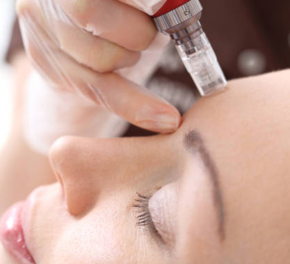 Microneedling with Peptides - November 2025 Special with Carolina in Miami