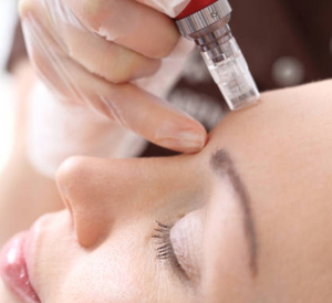 Microneedling + Toskani Advanced Cocktail - February 2025 Special