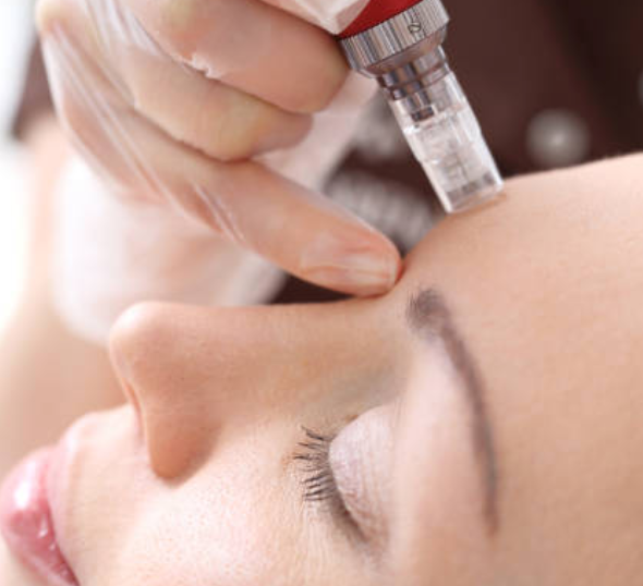 Microneedling + Toskani Advanced Cocktail - February 2025 Special