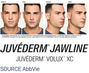 Jawline Filler 3 Syringes of Juvederm Volux