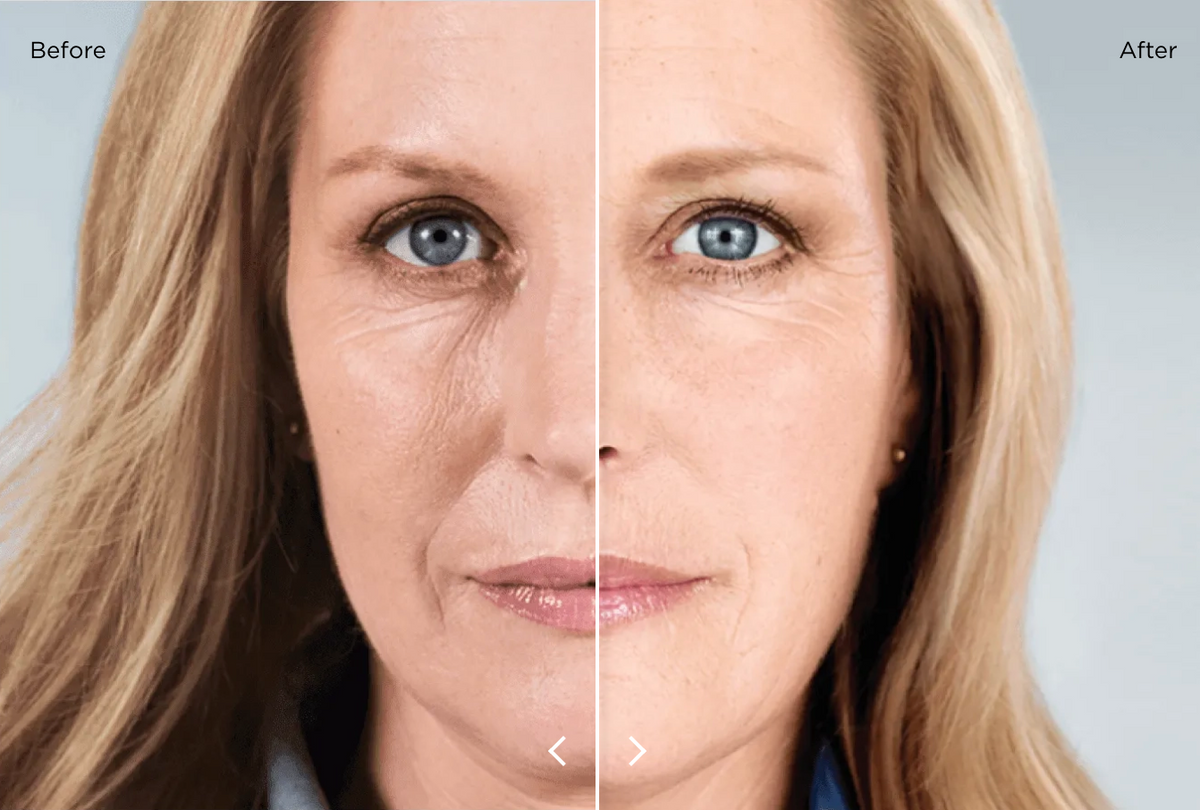 Sculptra 2 Vials New Image Works Sculptra 2 vials new image works
