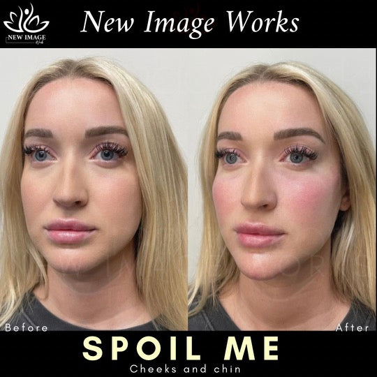 Spoil Me + 1 Syringe FREE - May 2025 Special
