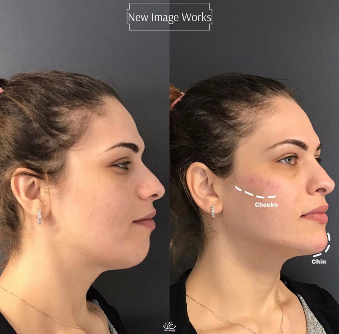 How Many Syringes for Cheek Filler: Expert Guide to Perfect Volume