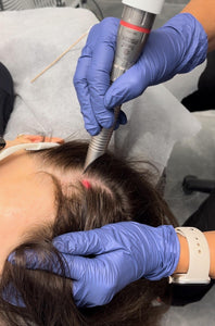 Fotona HairLase Restoration 3 Treatments