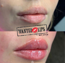 Load image into Gallery viewer, Juvederm Lip Filler (&quot;Wanted Lips&quot;)

