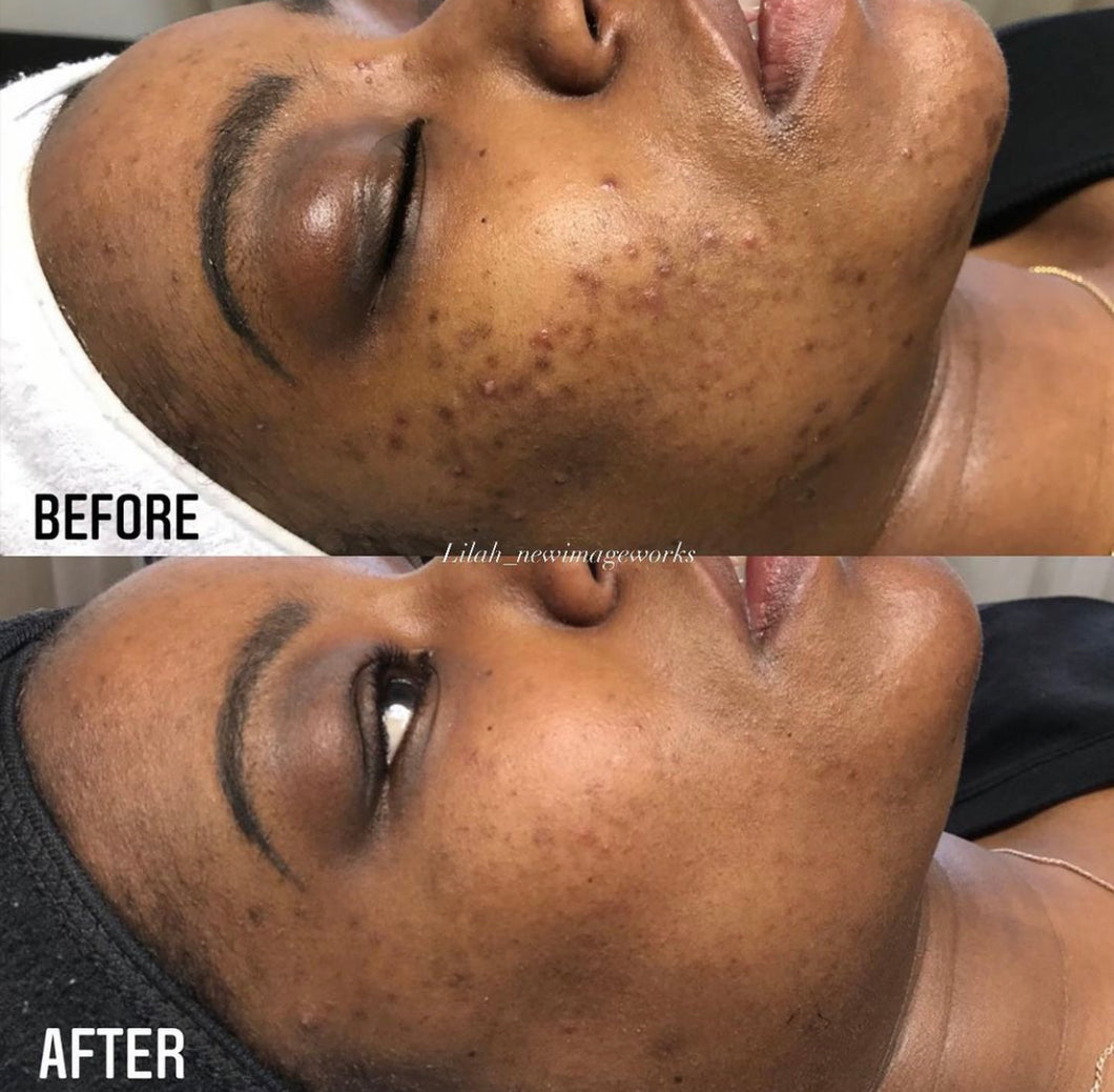 Resurface Me (3 Microneedling with PRP [topical application] + 3 Dermaplanning)