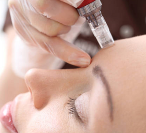 Microneedling 1 Area - 3 Sessions