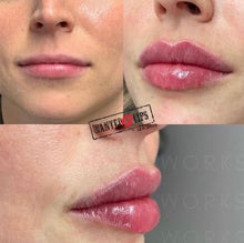 Load image into Gallery viewer, Juvederm Lip Filler (&quot;Wanted Lips&quot;)
