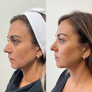 Sylfirm X Fractional RF 2 Area (Face and Neck)